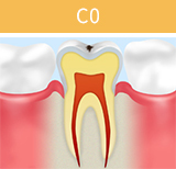 虫歯の進行段階と治療法_01