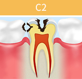虫歯の進行段階と治療法_03