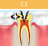 虫歯の進行段階と治療法_04