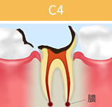 虫歯の進行段階と治療法_05