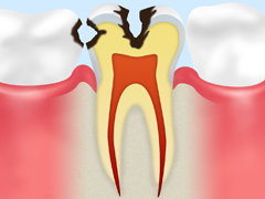 【C2】象牙質に達した虫歯